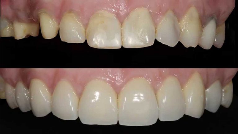 Corona dental en Juliaca: Cubre y fortalece tus dientes (sonrie)