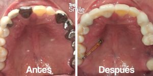 corona dental juliaca topsmile