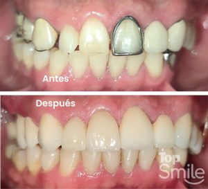 corona dental juliaca topsmile antes y despues