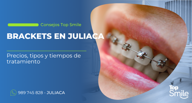 Brackets en Juliaca | Corrige tu sonrisa con los especialistas de Top Smile