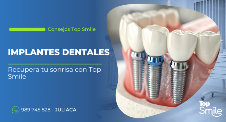 Implantes dentales en Juliaca