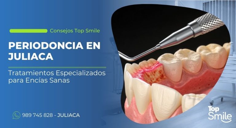 Periodoncia en Juliaca para tratar gingivitis y periodontitis. En Top Smile cuidamos tus encías con especialistas y tecnología moderna. Agenda tu cita hoy.