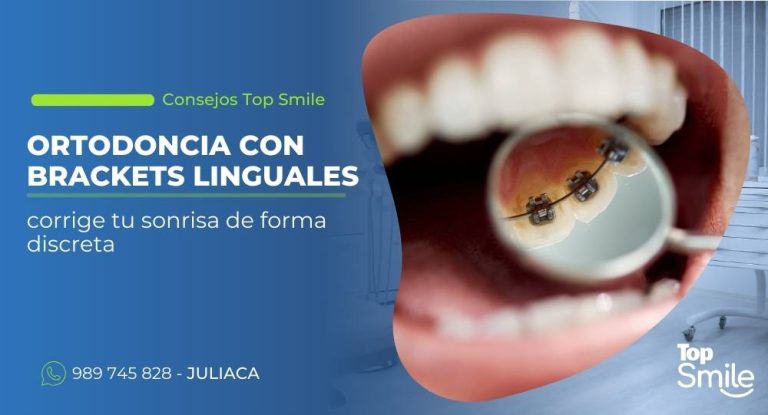 ortodoncia con brackets linguales en Juliaca