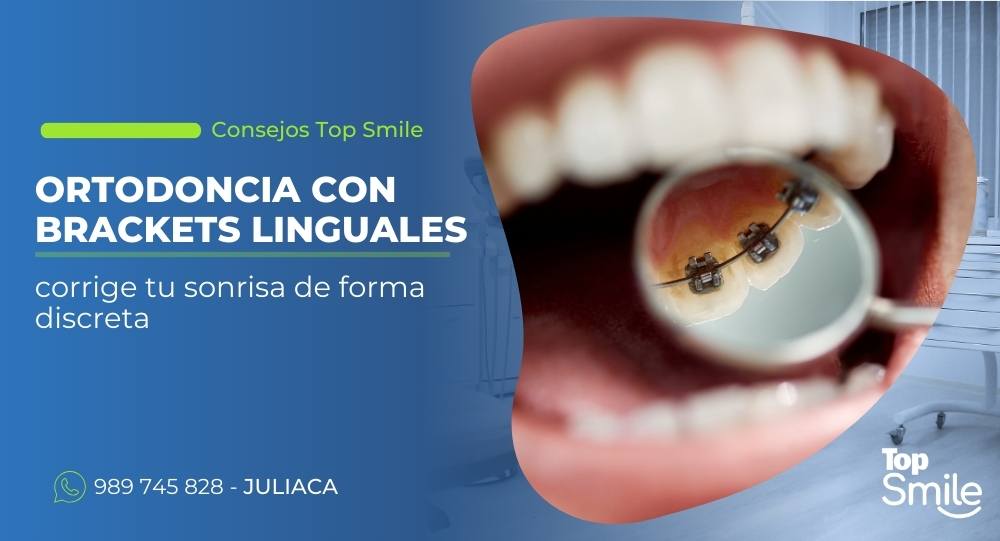 ortodoncia con brackets linguales en Juliaca